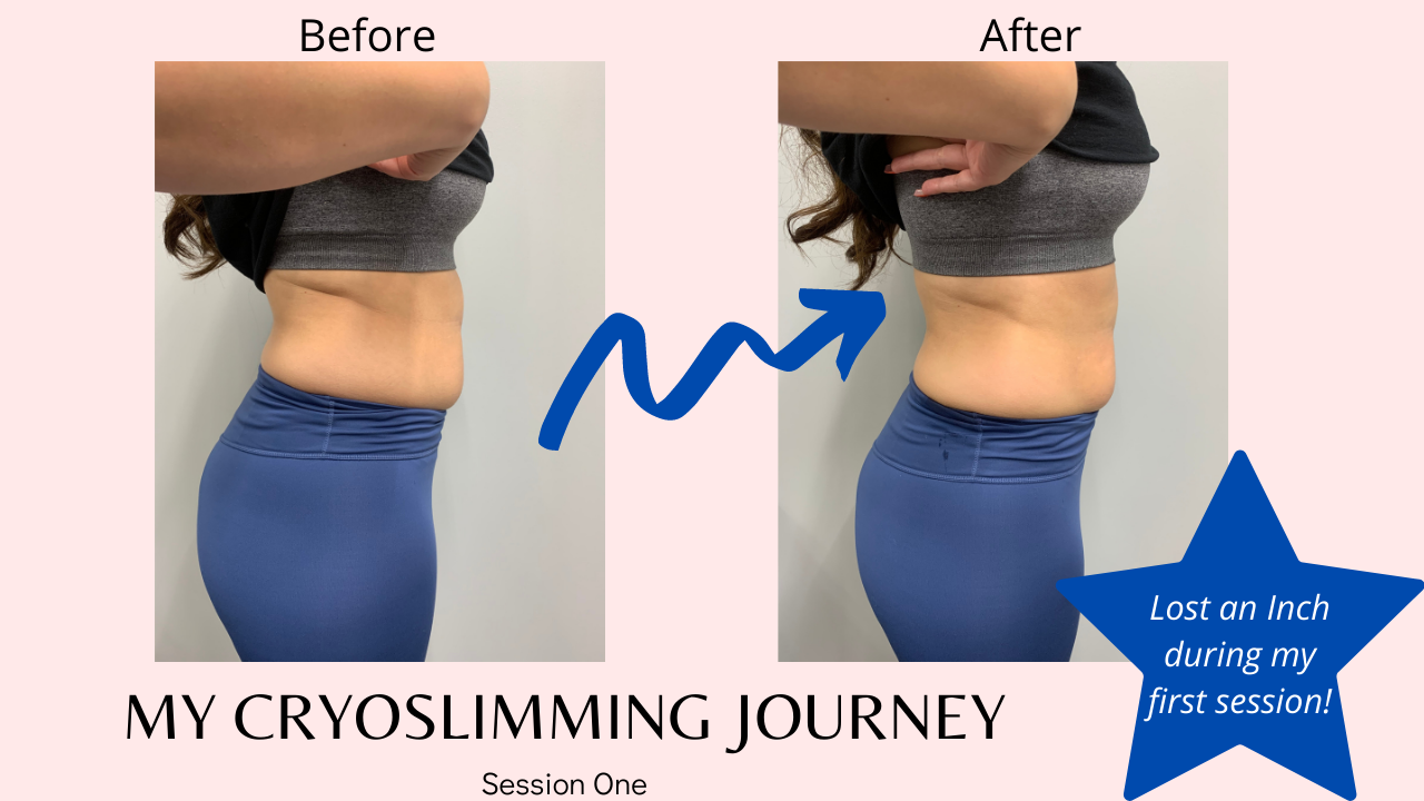 Cryoslimming - what to expect in your first session and how it