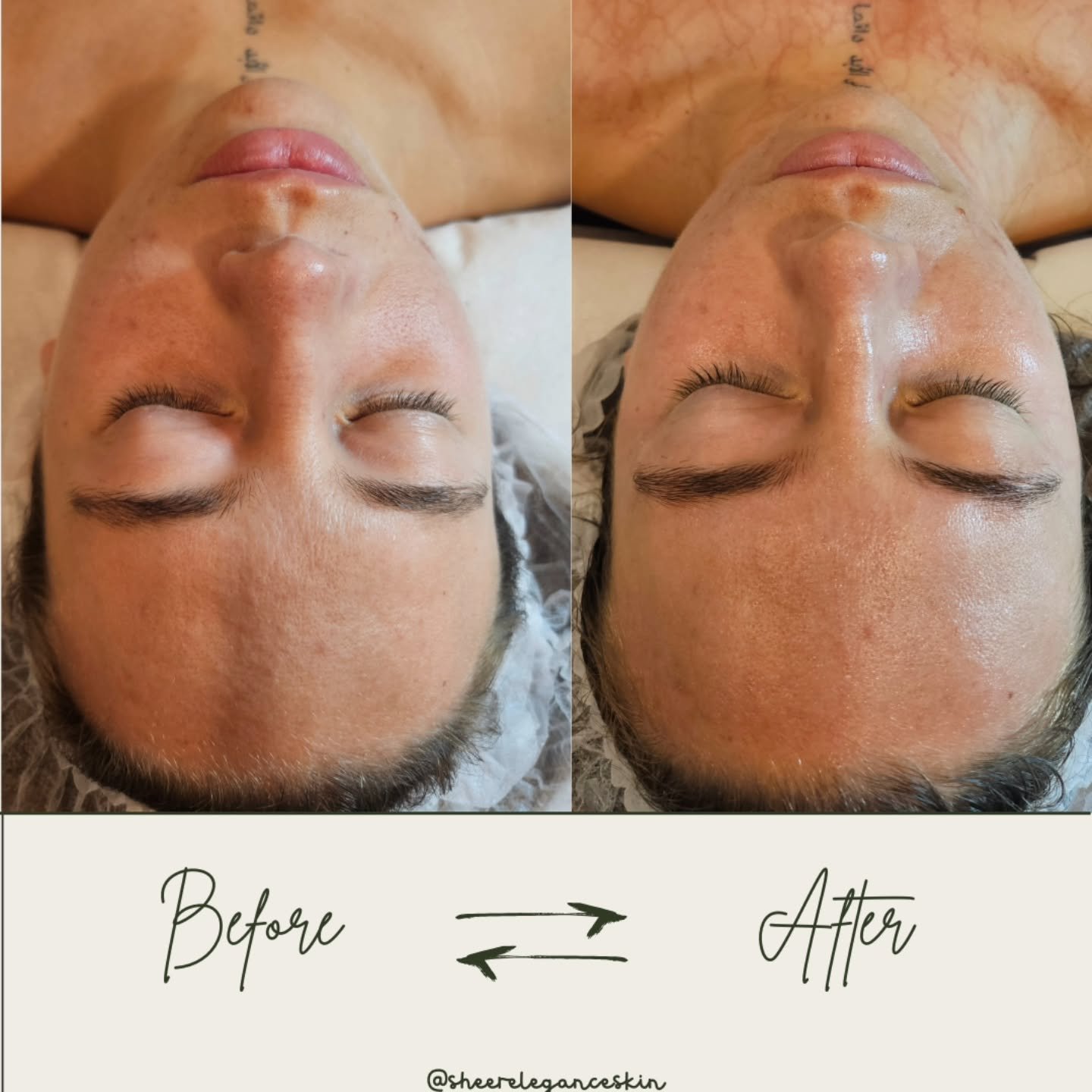 Post Enzyme Therapy Facial Glow 💫

A combination of peel and transfer messenger enzymes oxygenate, strengthen and nourish the skin.

Happy, healthy skin starts with feeding the skin what it needs. Amino Acids, Vitamins and Minerals support skin hydr