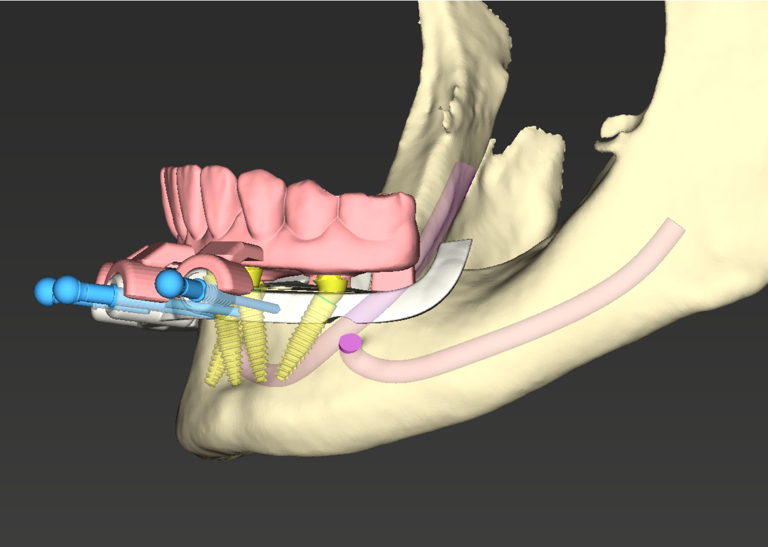 Restorative Solutions for Patients Missing Single and Multiple Teeth