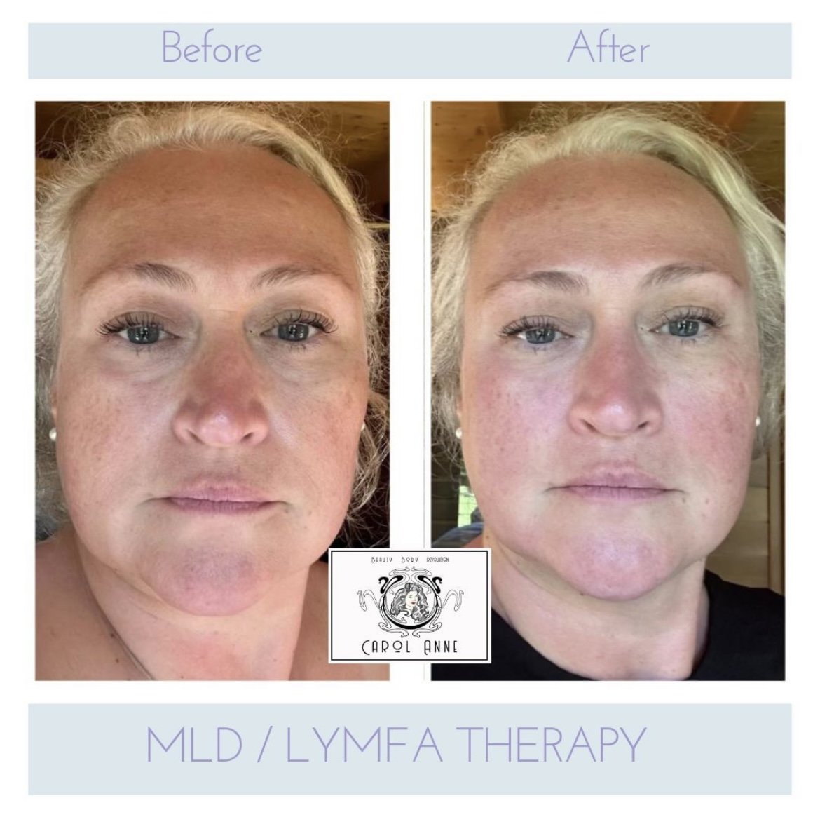 lympha therapy.jpg