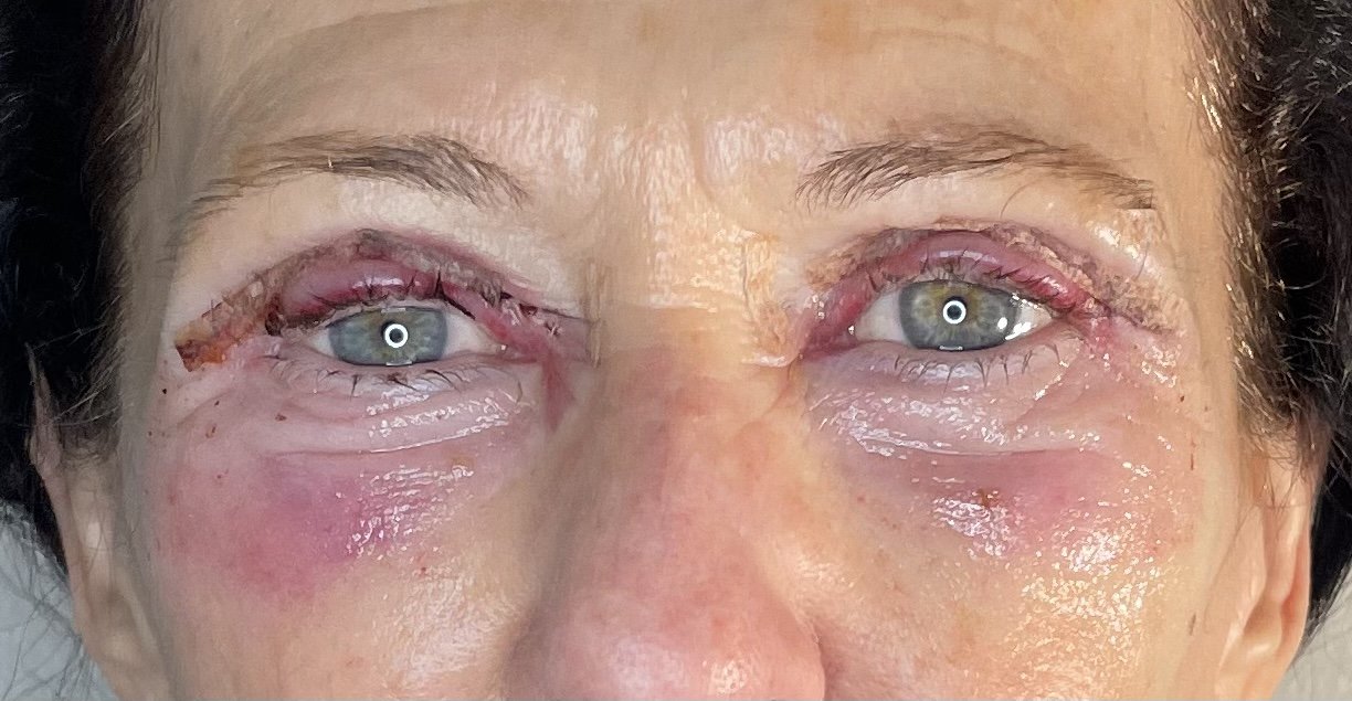 Client had Lymfa Therapy starting the day after surgery.