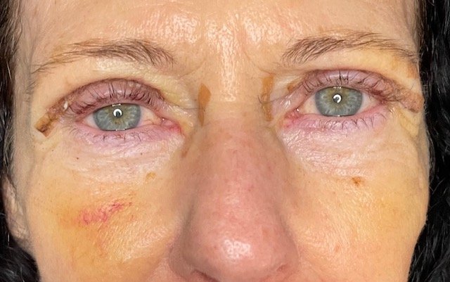 Before and after is a total of ten days.