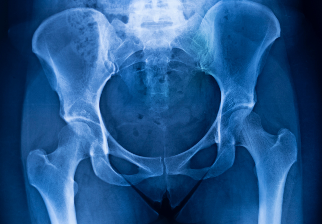“Do I need a new hip?”