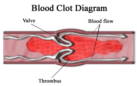 clotting.png