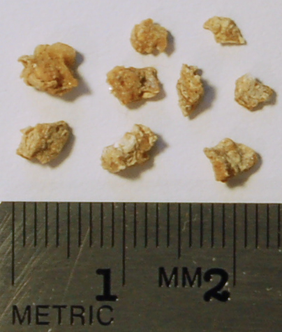 Kidney_stone_fragments.png