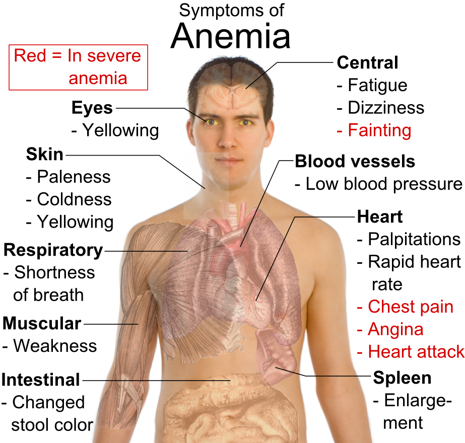 Symptoms_of_anemia.png