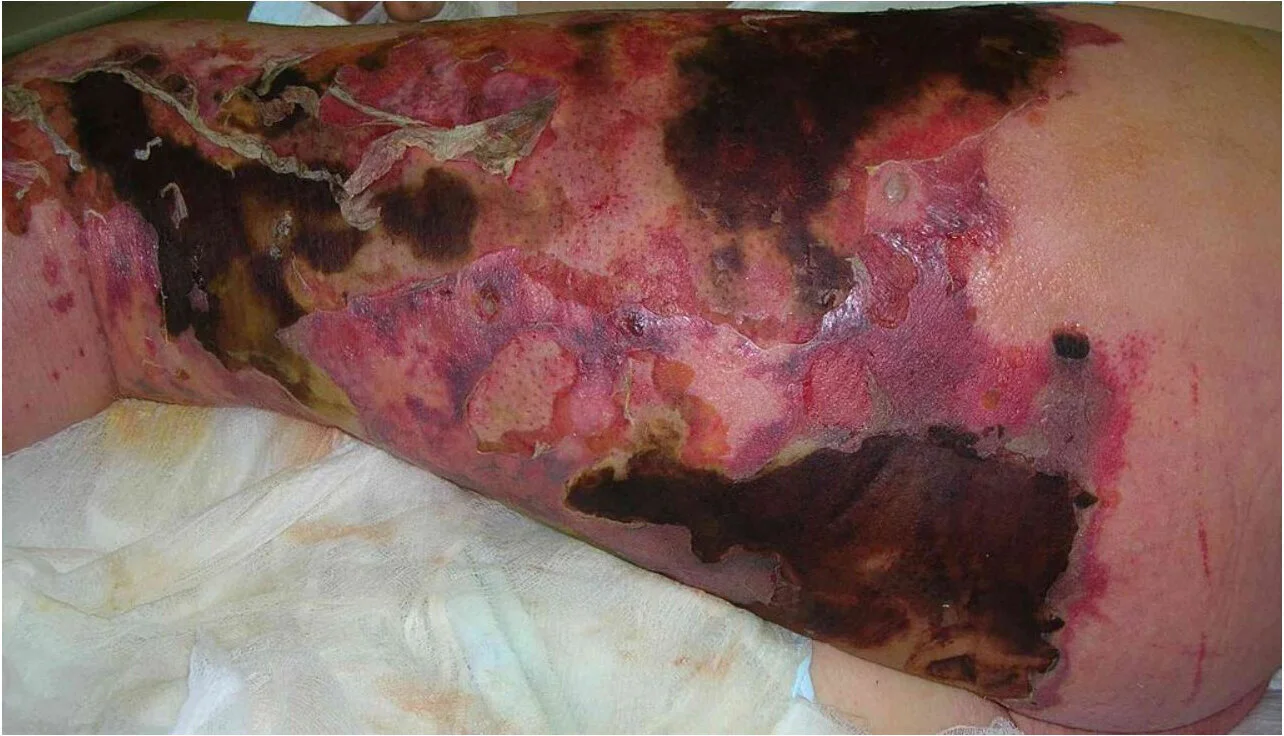 Contagion Options: Necrotizing Fasciitis
