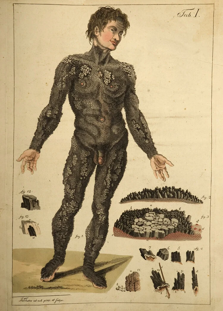 Contagion Options: Ichthyosis