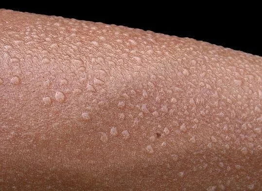 Physical Mutation Drawback: Hyperhidrosis