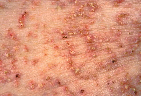 Physical Mutation: Absorb Disease