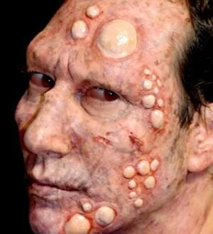 New Mutant Monday Series Two #10 - Pustuloid