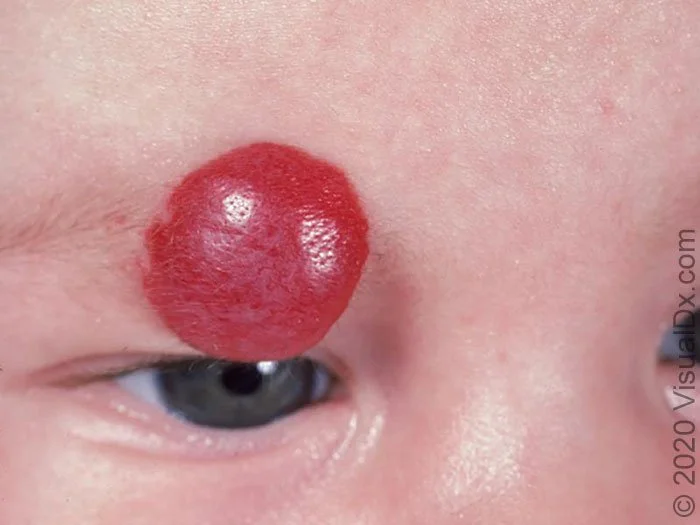 Everything you wanted to know about birthmarks! — The PediPals