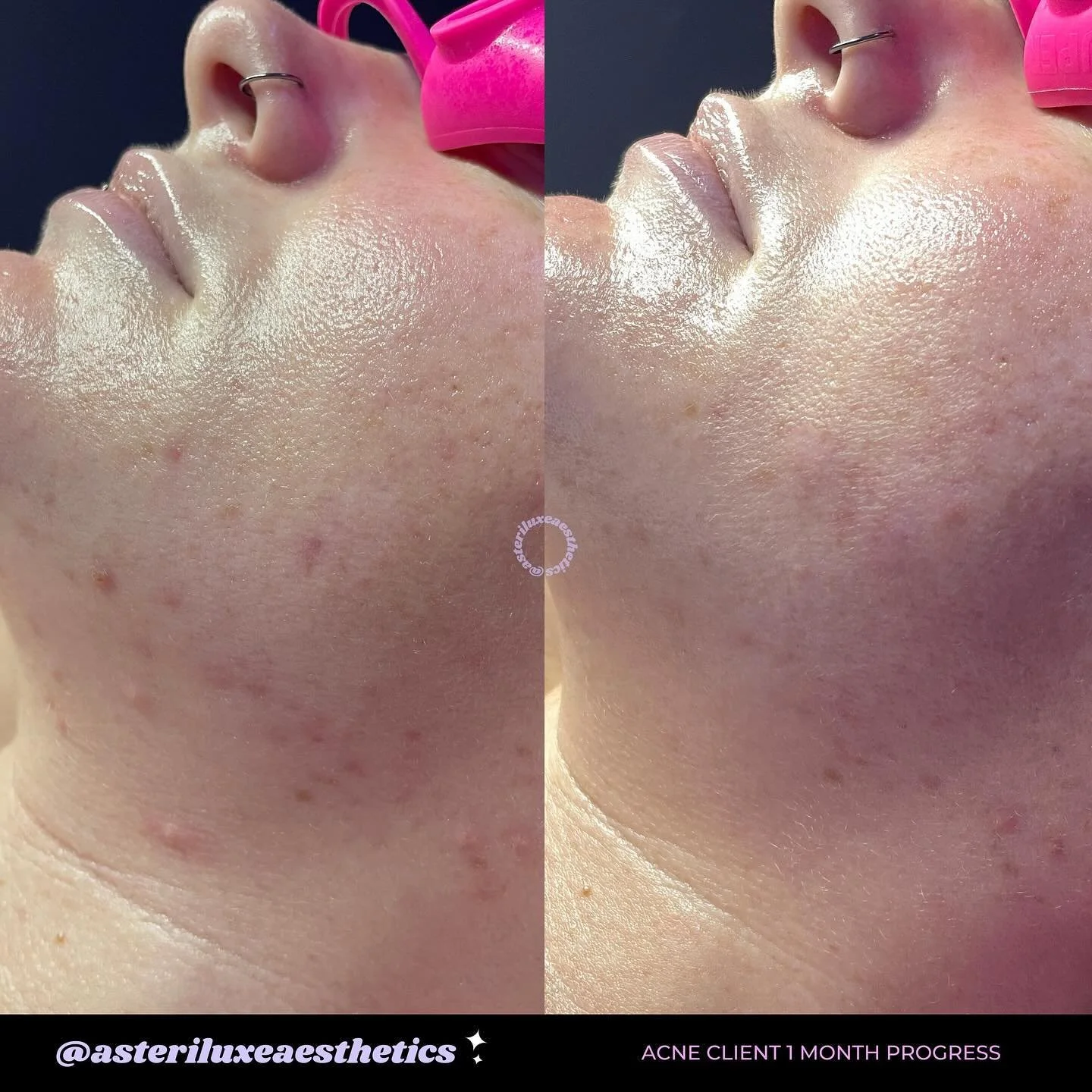 ✨ Acne who? ✨

🥹 so proud of this client! In just one month she cleared up WHILE pregnant 🙌🏽

Acne clearing is possible even during pregnancy/nursing. It just takes a good skincare regimen and lots of consistency! 💕

#acne #acnepositivity #acnetr