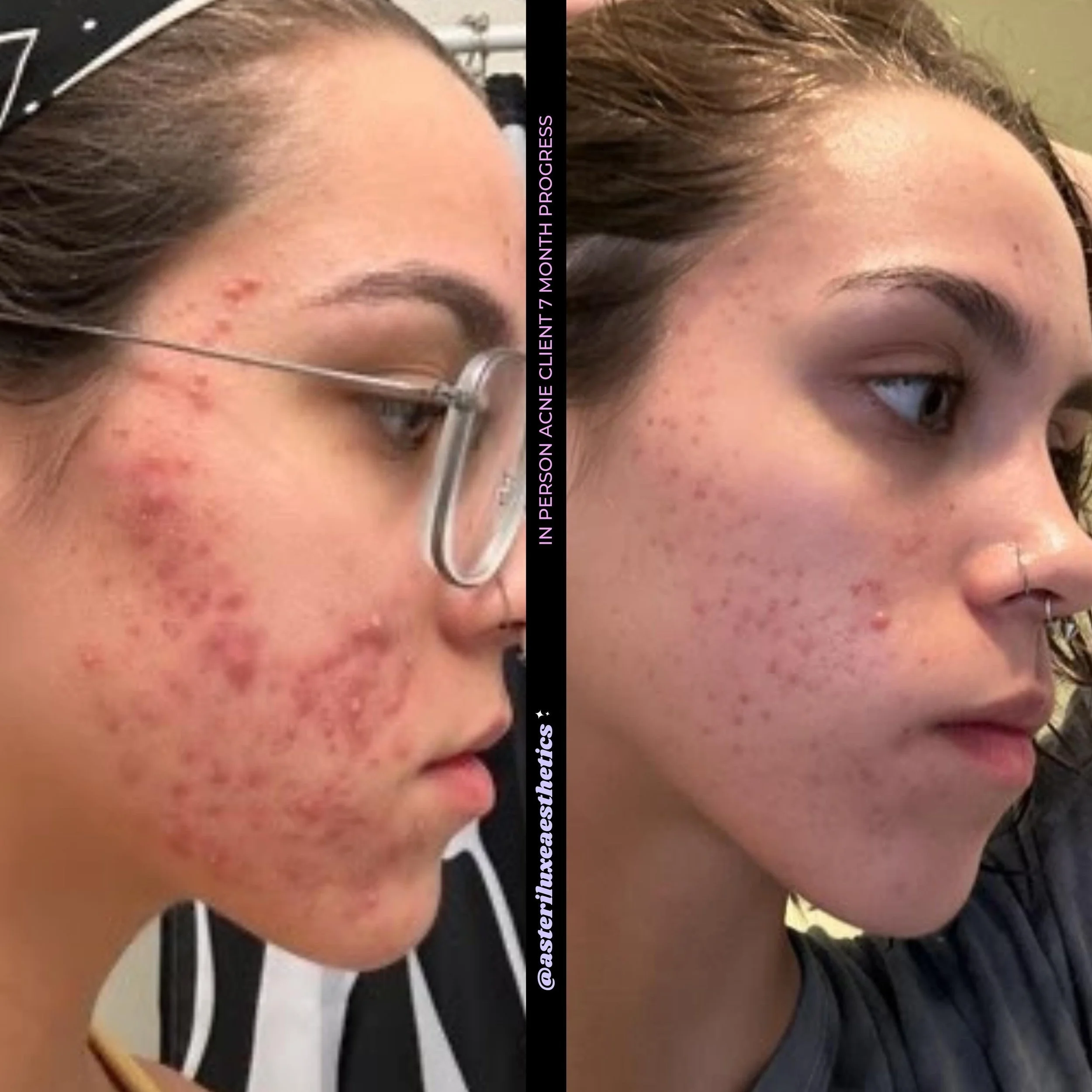 ✨ Acne clearing is possible ✨

You all have no idea how PROUD I am of this client. It took a few months to get to this point but her perseverance and commitment is the key takeaway 💕 Even though there were tough times and moments of discouragement, 