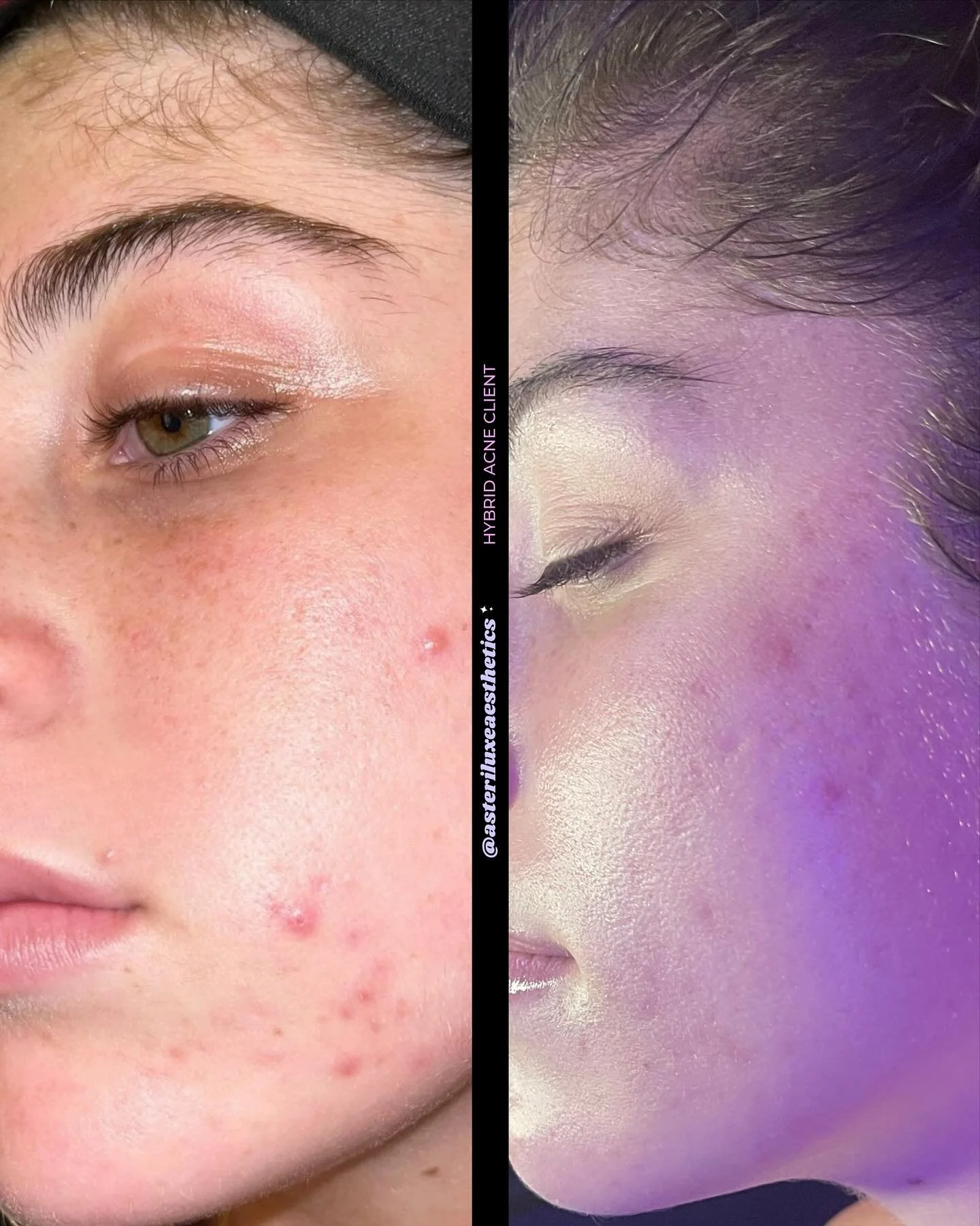 I&rsquo;m sorry, acne who? 🤔

It was quite a long journey, but I am so extremely proud of this client for never giving up 🙏💕 She trusted me every step of the way throughout my acne program and we are not finished! We are now working on maintaining