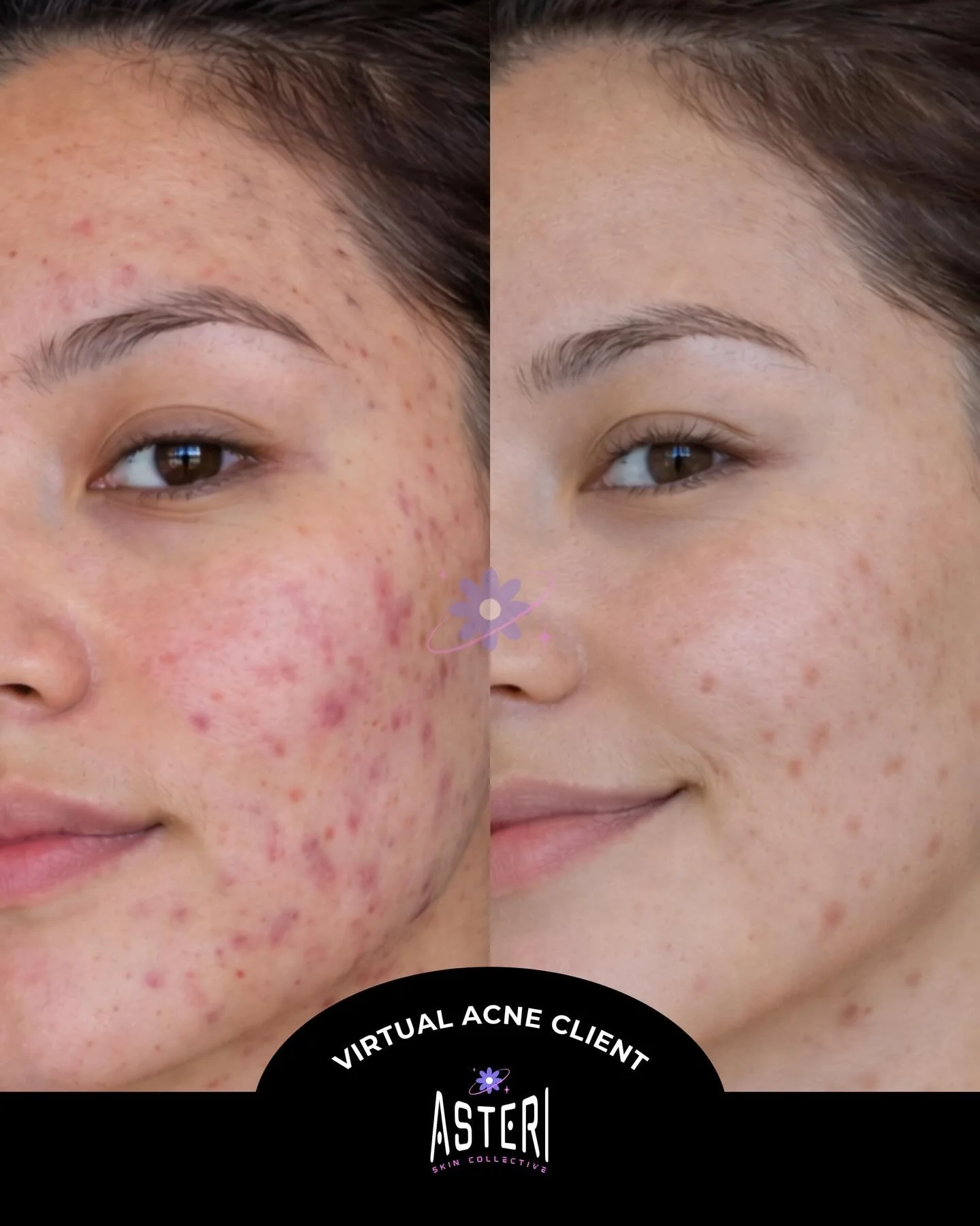 When you follow up with your acne clients and they are SMILING in the progress photos 🥹💕 And this was all done virtually with a customized routine I created specifically for them! ✨

If you have been looking for an acne expert to help guide you to 