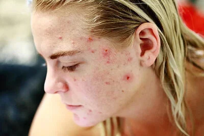 Chronic Inflammatory Conditions