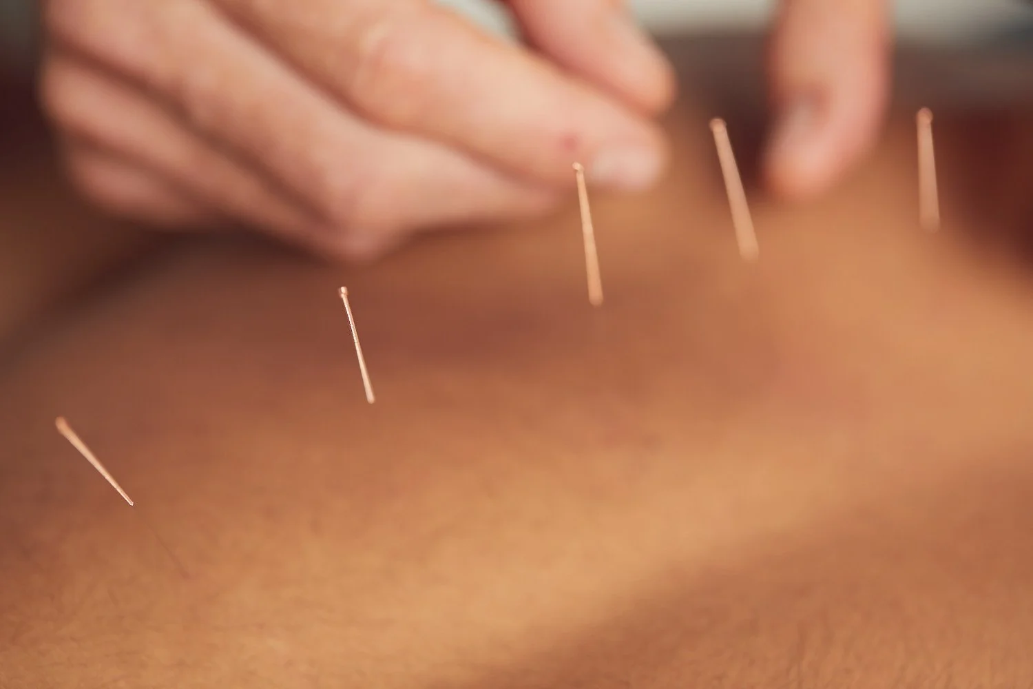Dry Needling vs Acupuncture: Which one is for you?