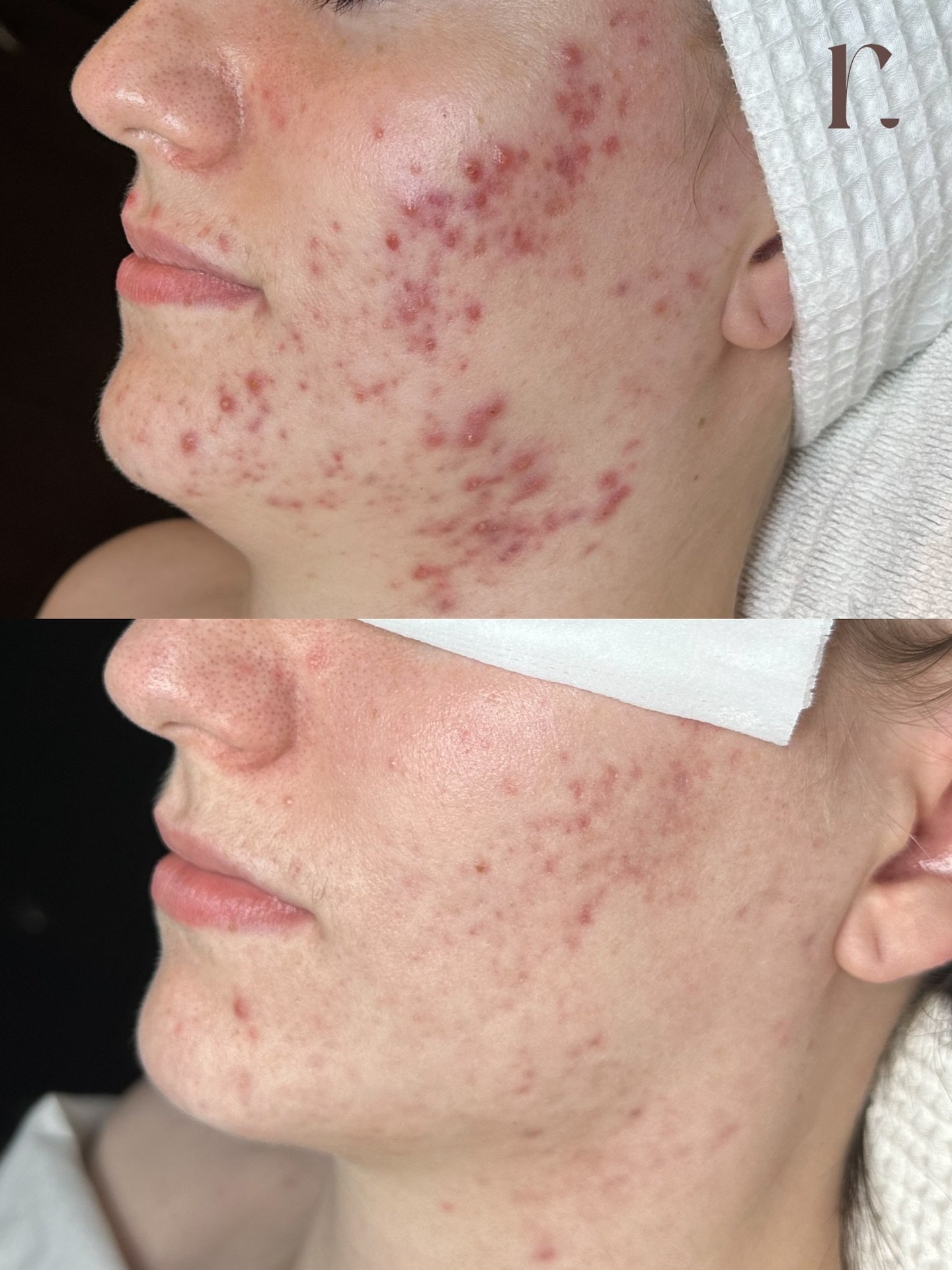 Acne Awareness Month💫🫶🏻🧚🏽&zwj;♀️

You are not alone, acne is our number one concern that we work to improve. Everyone&rsquo;s acne is different, everything must be customized to your skin. 

One thing we do know for sure; medical grade skin care