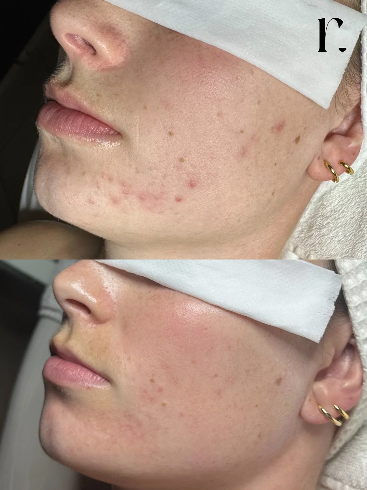 Bringing back the glow✨

How did we achieve this? 

Regular facials targeting active acne/pigmentation and an in depth home care routine to support her hard work in the treatment room! 

Homecare: 
Pre Cleanse
Essentials Cleanser
B5 Serum 
Dermaclear