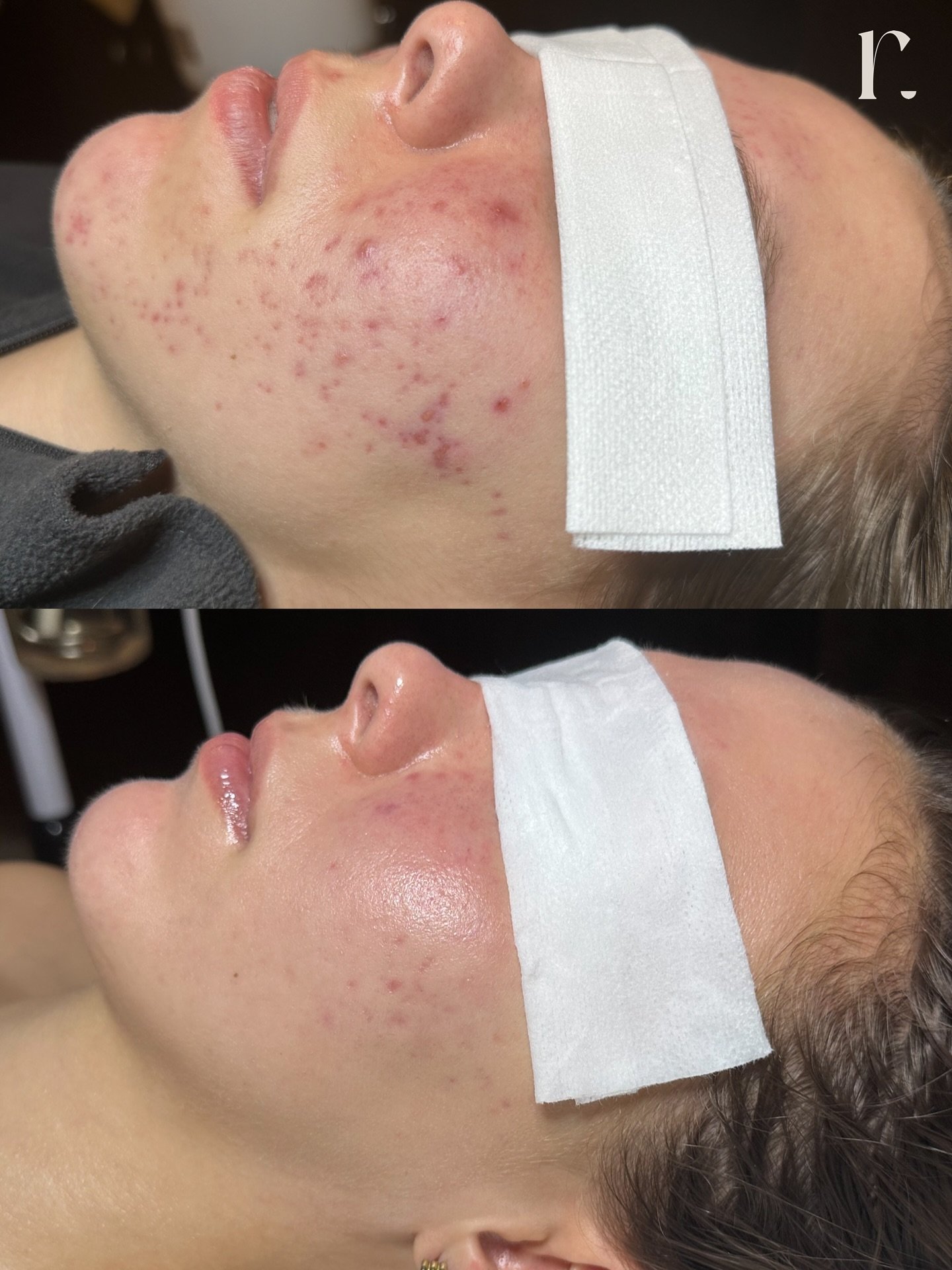 More before &amp; afters coming in hot 😦🔥

We are SO excited for this amazing client, these results are due to hard work both at home and in the treatment room. 

Let&rsquo;s talk skin, book your complementary consultation today! 👥