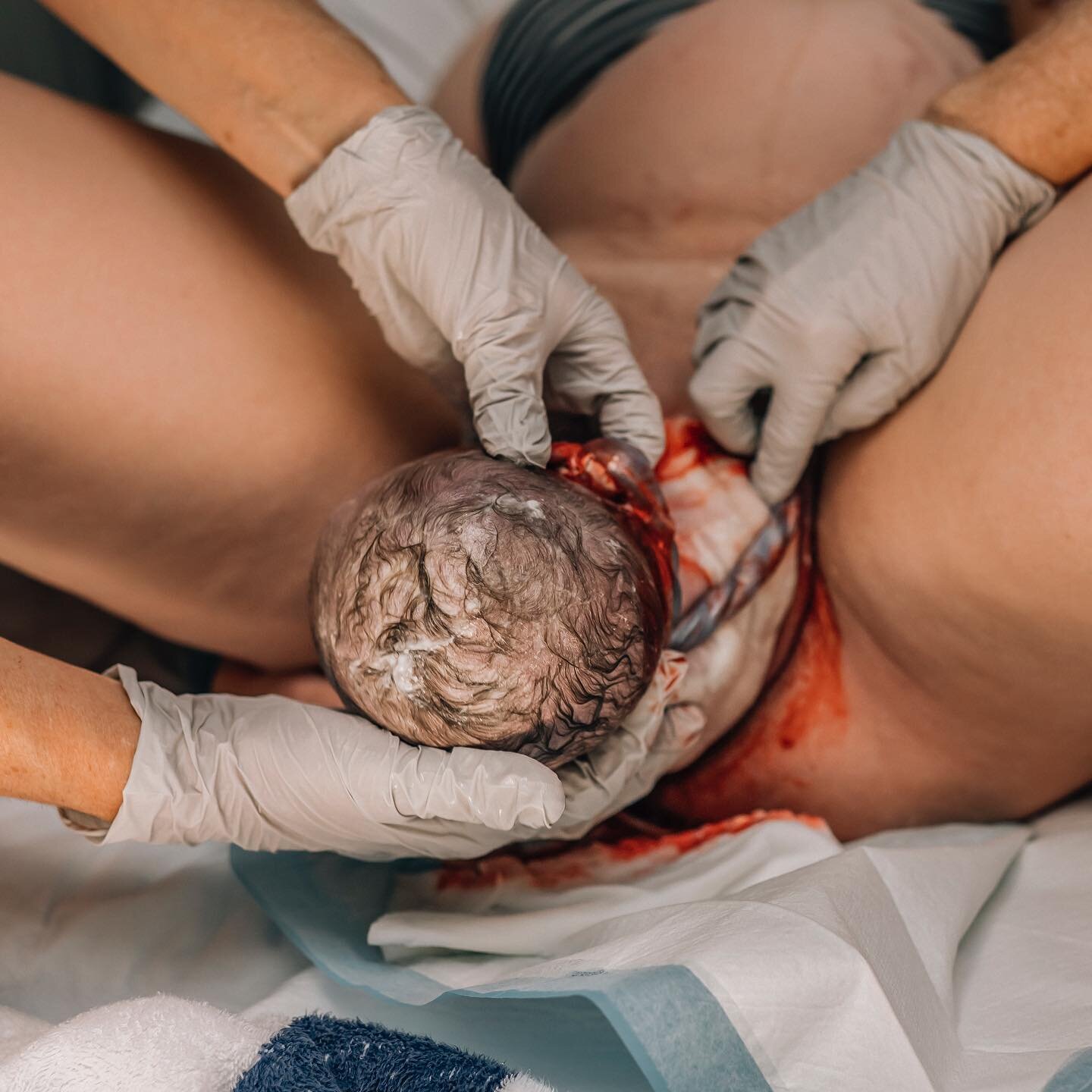Did you know that around 1 in 3 babies are born with a nuchal cord? 

It's very common for babies to have their cord around their neck, and it's rarely problematic. A few quick maneuvers by the midwife and it's usually resolved within seconds 🥰💕
.
