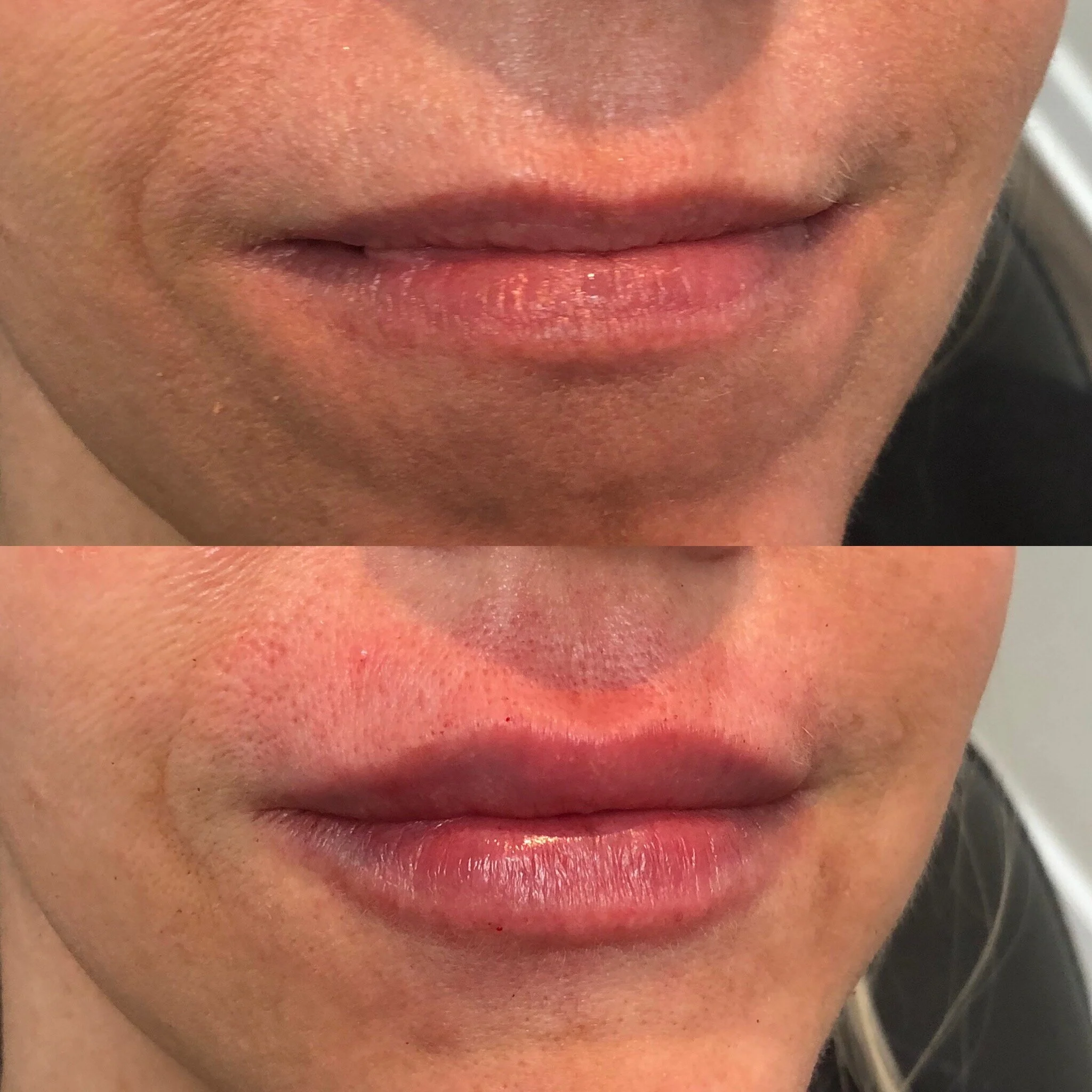 Results — Infinity MedSpa and Wellness Charlotte NC