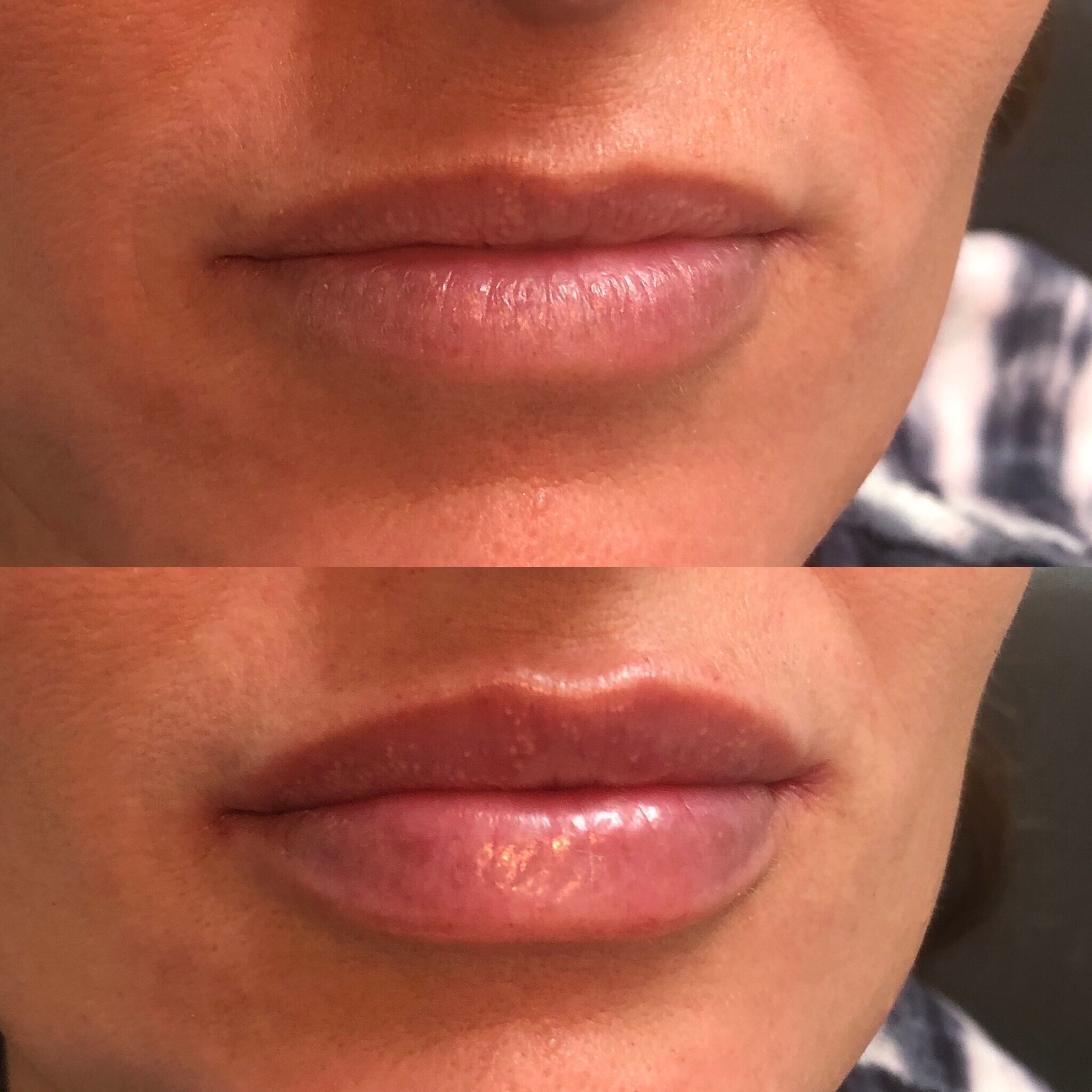lip fillers near me afterpay
