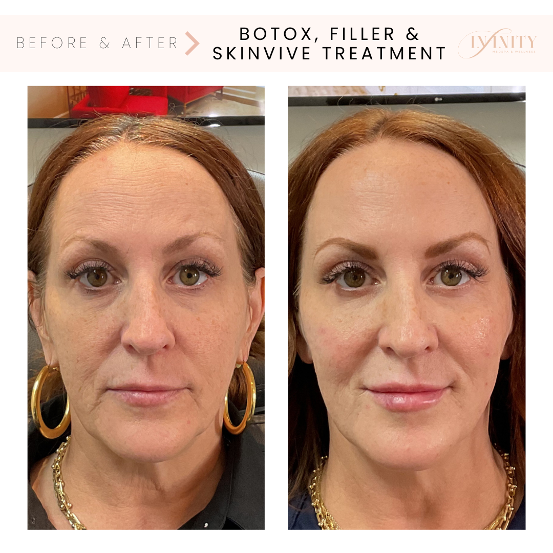 Botox_Skinvive_lipfiller_cheekfiller_chinfiller_infinitymedspa_charlottenc.png