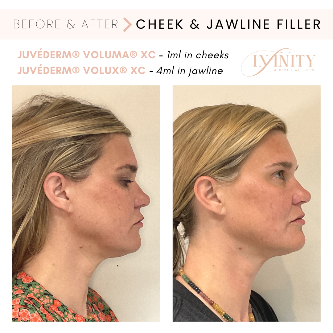 cheekfiller_jawlinefiller_charlottenc_beforeandafter_infinitymedspa.png