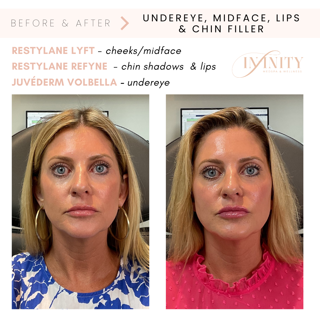 Cheekfiller_Undereyefiller_lipfiller_infinitymedspa_beforeandafter.png