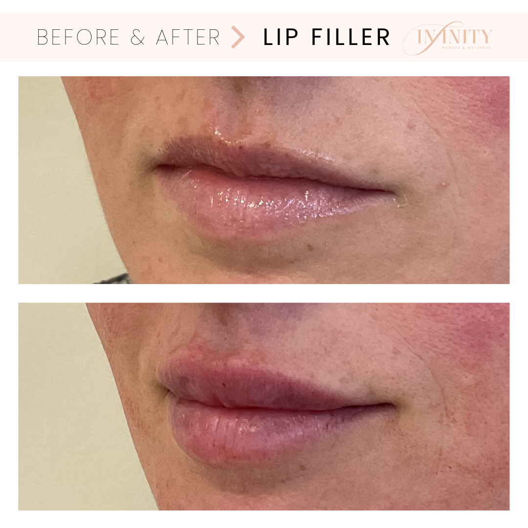 LipFillerbeforeandafterInfinityMedspaCharlotteNC.png