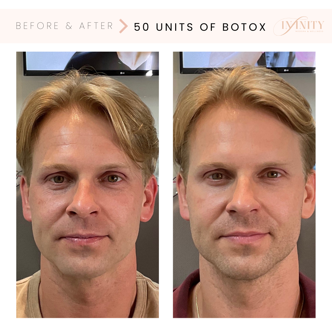 Botoxtreatment - Before and after man not smiling - Infinity medspa charlottenc.png