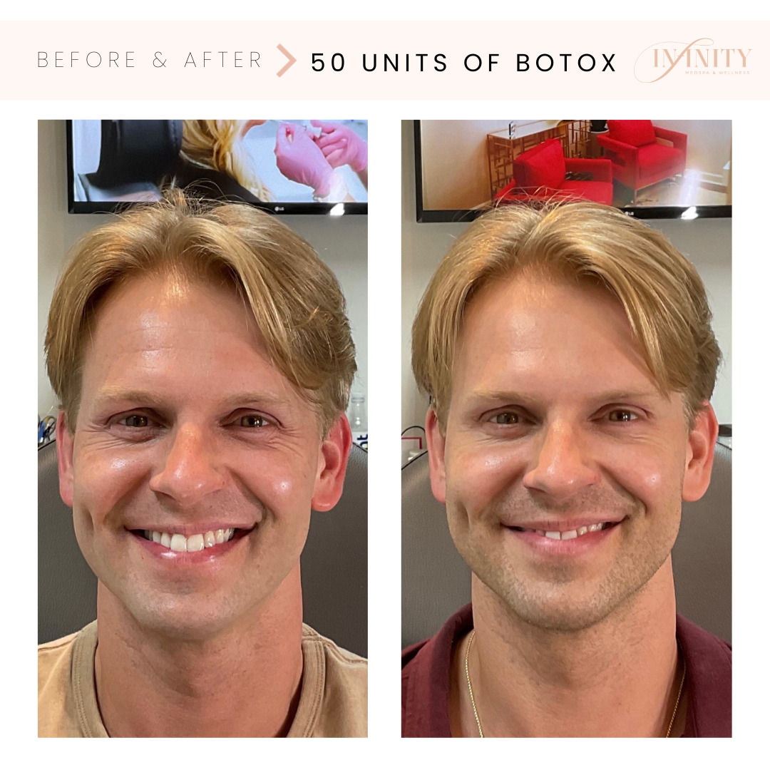 Botoxtreatment - Before and after man smiling - Infinity medspa charlottenc.png