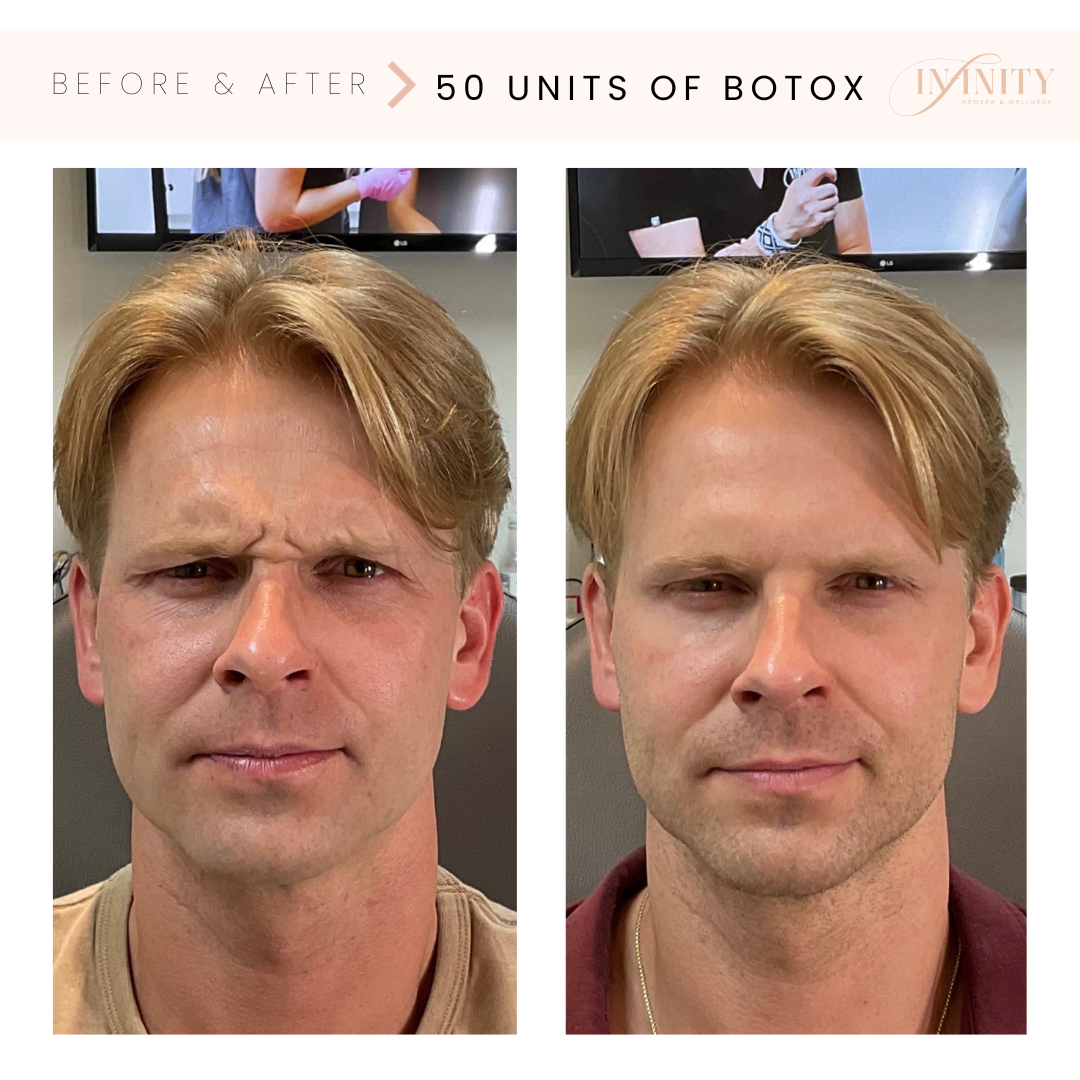 Botoxtreatment - Before and after man- Infinity medspa charlottenc.png