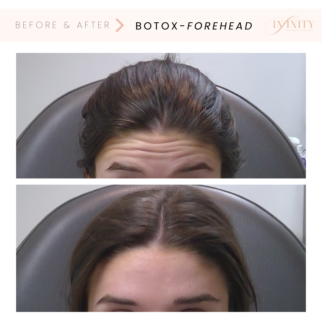 Botoxtreatment - Before and after WOMAN raising eyebrows- Infinity medspa charlottenc.png