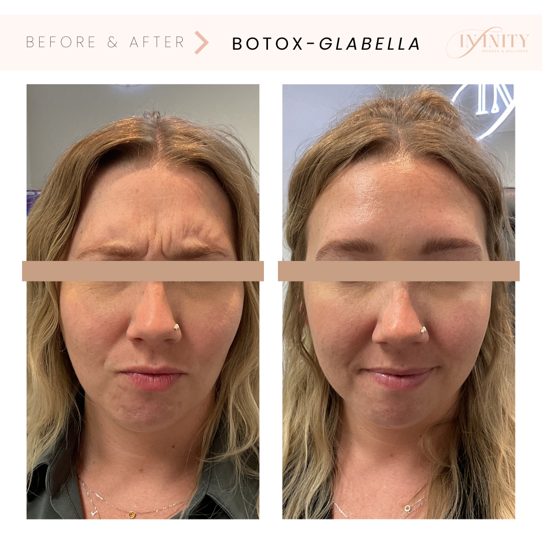 Botoxtreatment - Before and after WOMAN scowling- Infinity medspa charlottenc.png