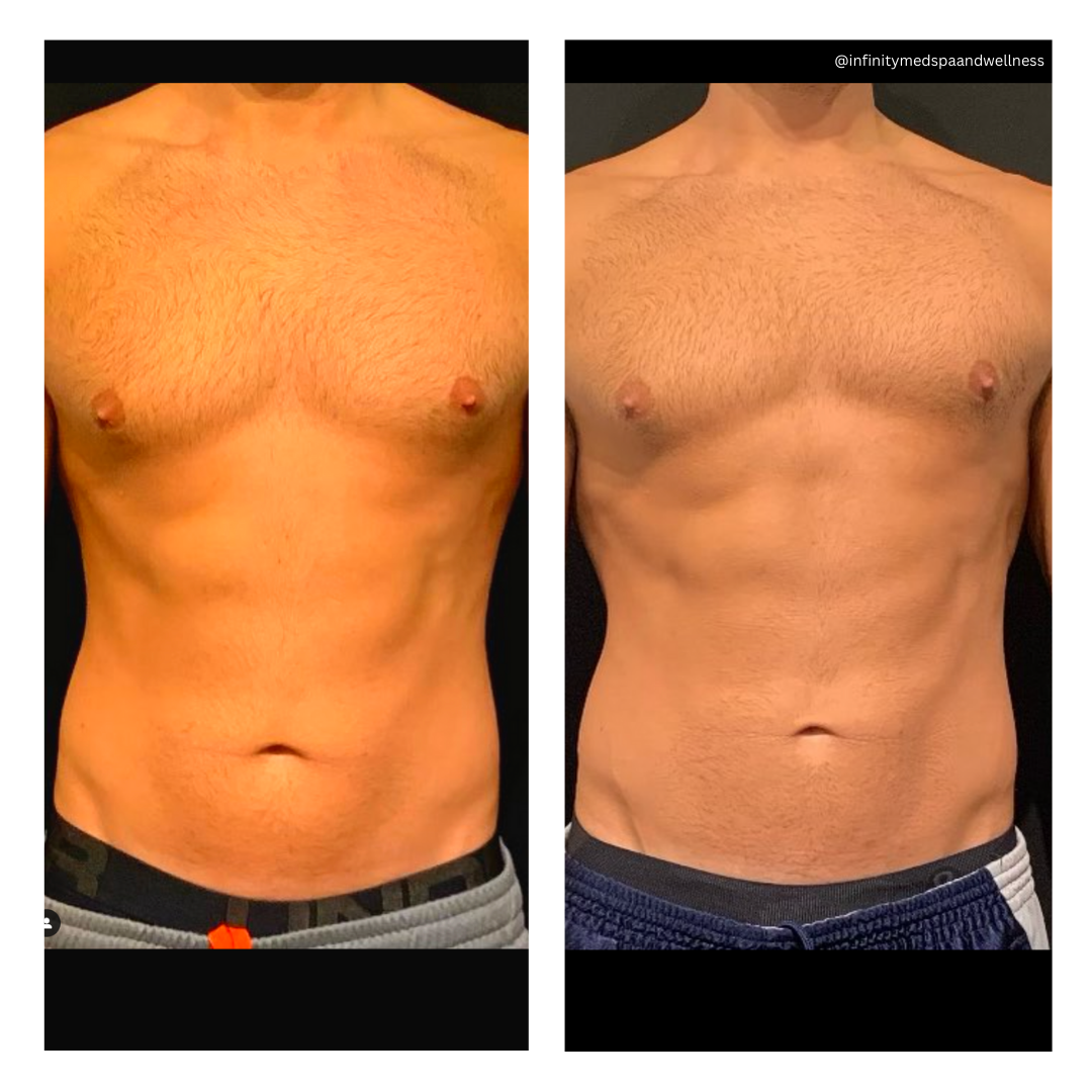 Coolsculpting Abs Before and After Infinity MedSpa