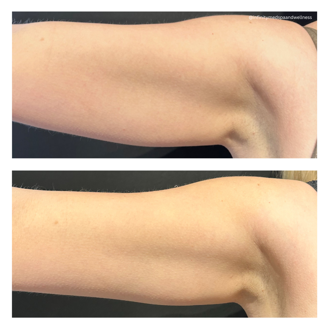 Before &amp; After Coolsculpting arm infinity medspa
