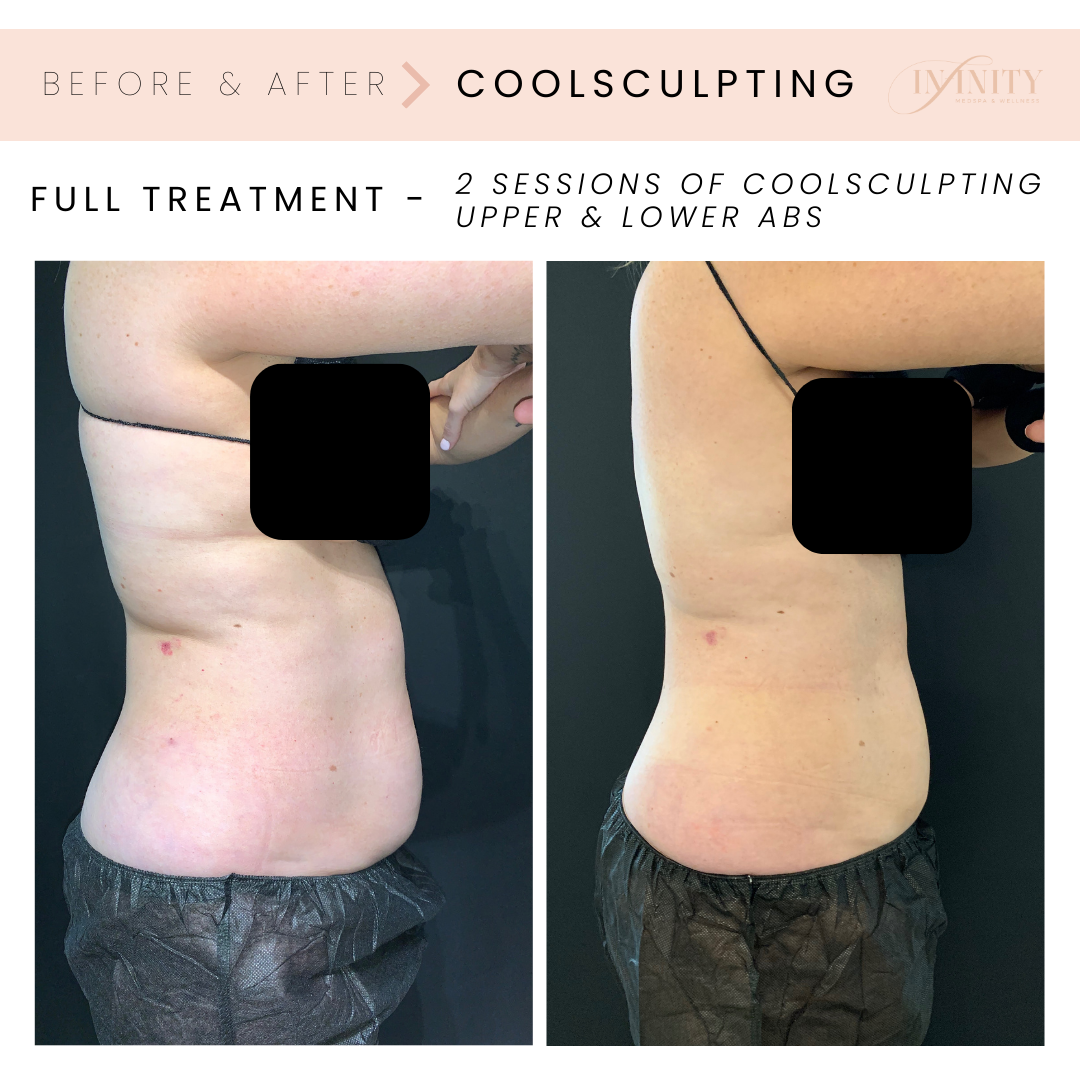 Before & After - Coolsculpting treatment SIDE.png