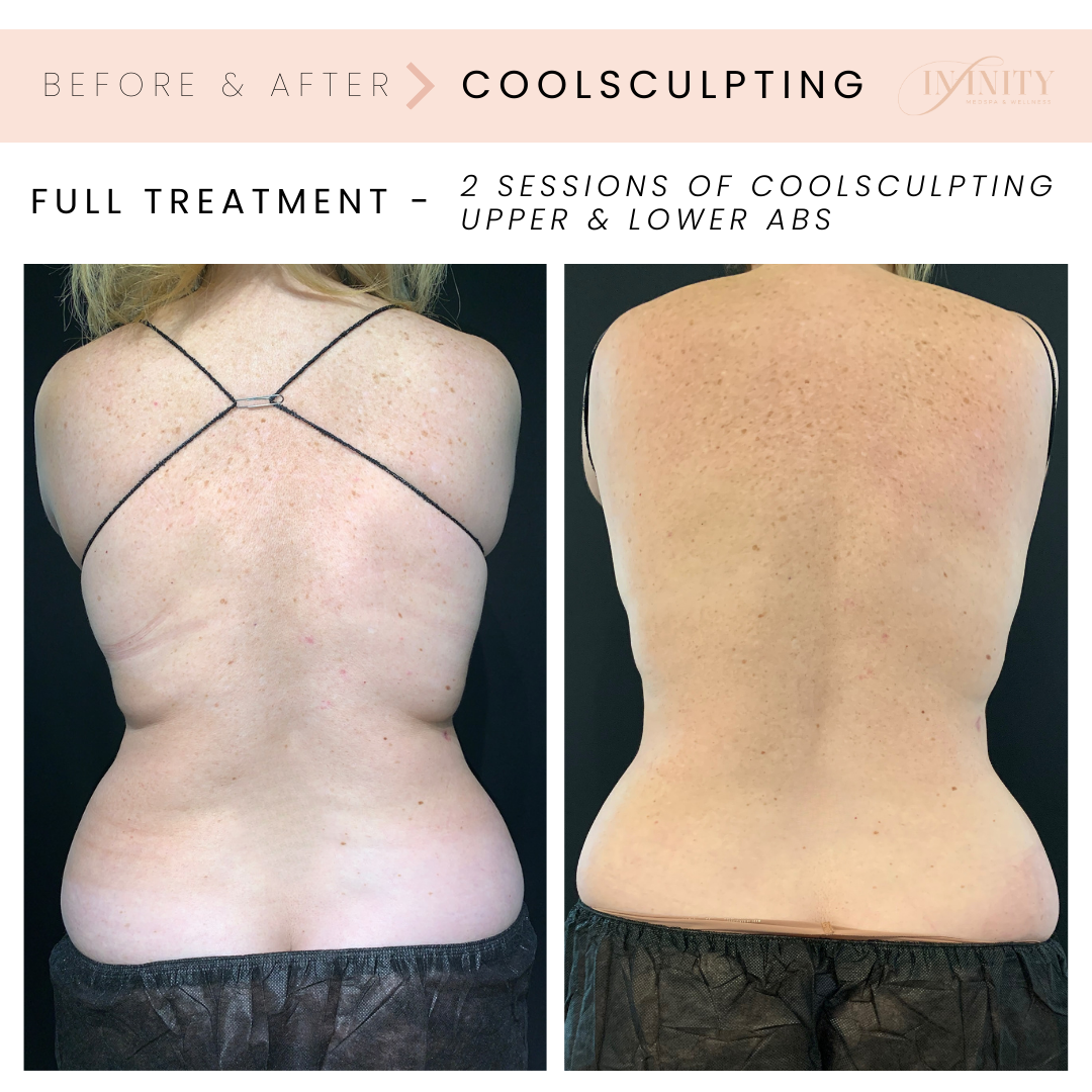 Before & After - Coolsculpting treatment BACK.png