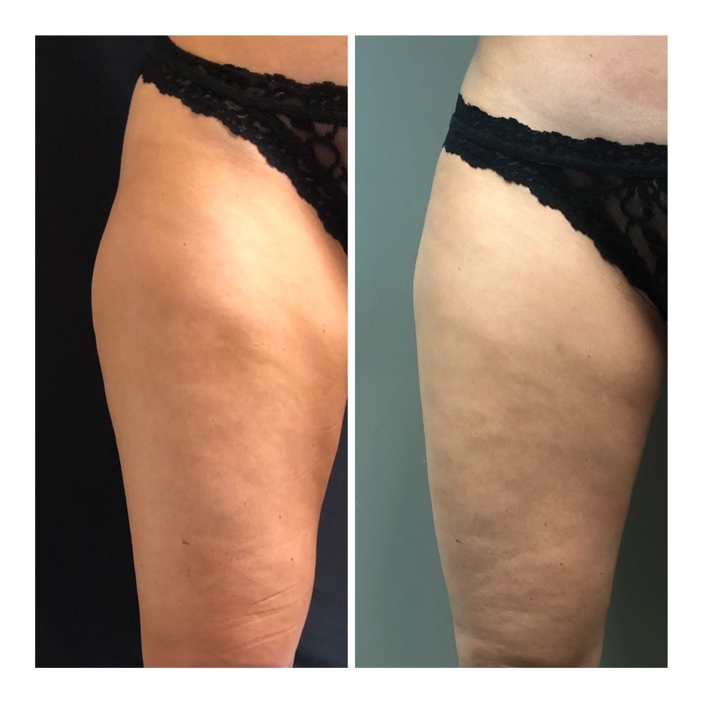 CoolSculpting Before &amp; After Outer thigh Infinity Medspa Charlotte NC