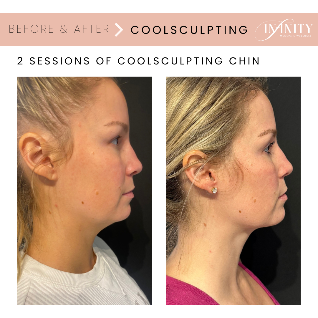 Coolsculpting Chin before and after infinity medspa charlotte nc.png