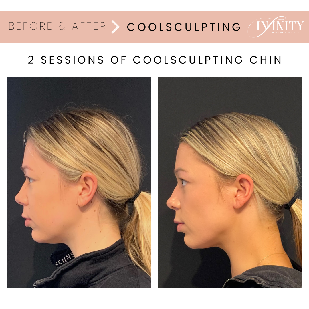 Coolsculpting Results Double Double Chin Coolsculpting Infinity Medspa Charlotte NC.png