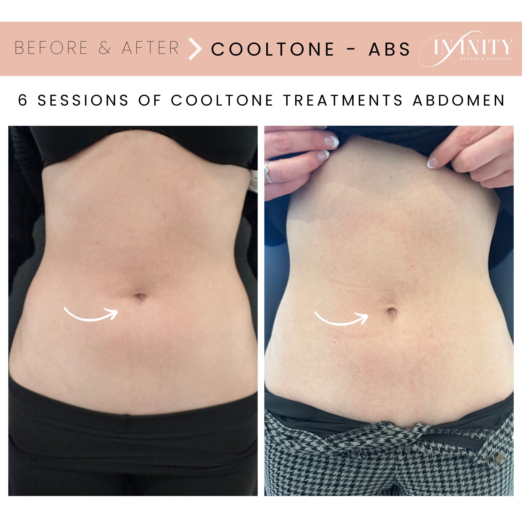 Strengthen &amp; tone with CoolTone! 💪

This patient saw tightening and toning of her abdomen with 6 sessions of Cooltone treatment with @your_esti_casey!

Cooltone treatment is perfect before your big trip this summer!
We recommend 6 to 8 sessions 