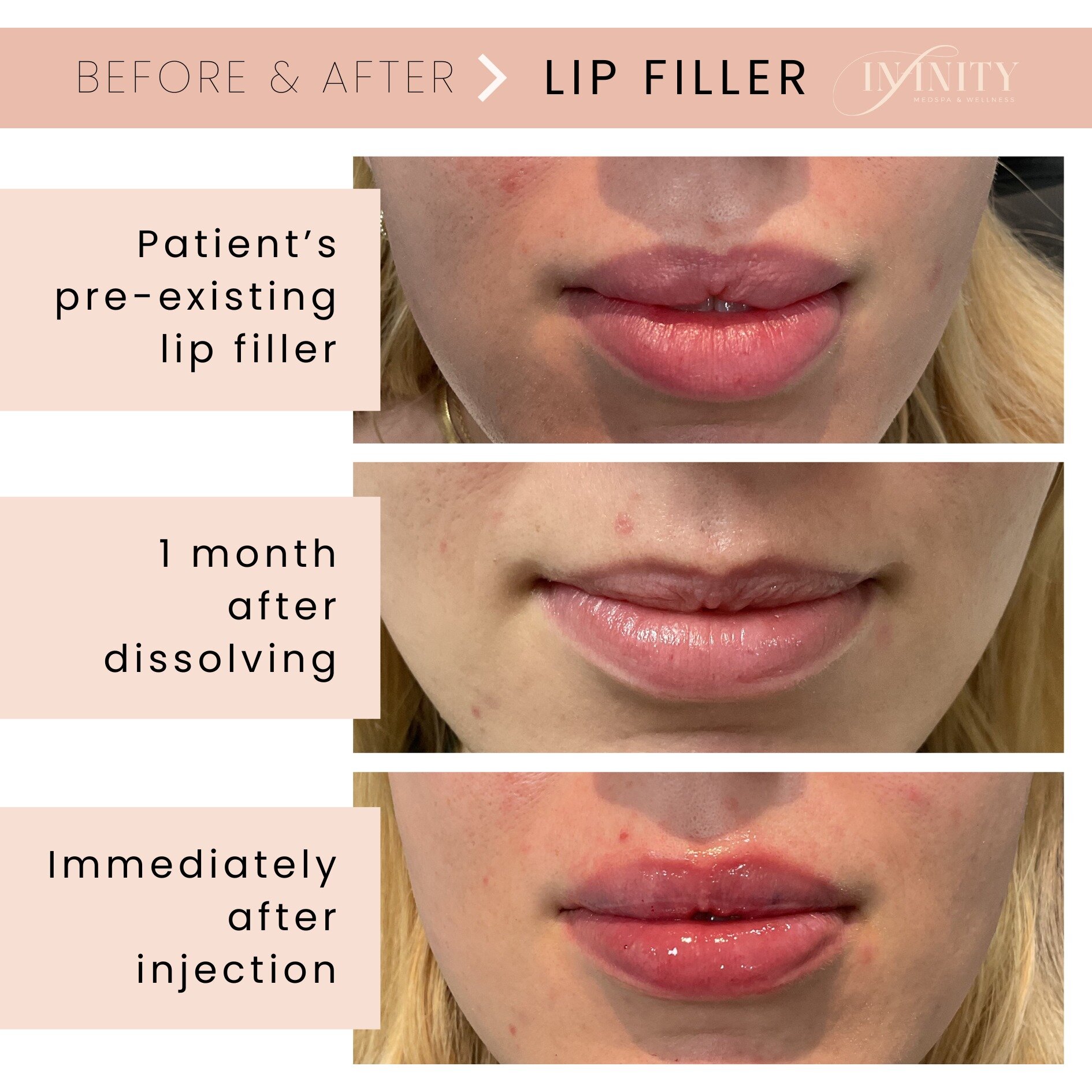 Every new patient with pre-existing lip filler gets assessed for migration &amp; over filling!

Our Providers will not add additional filler if they have concerns of losing the natural shape.

⭐ In this case, the patient had several rounds of lip fil