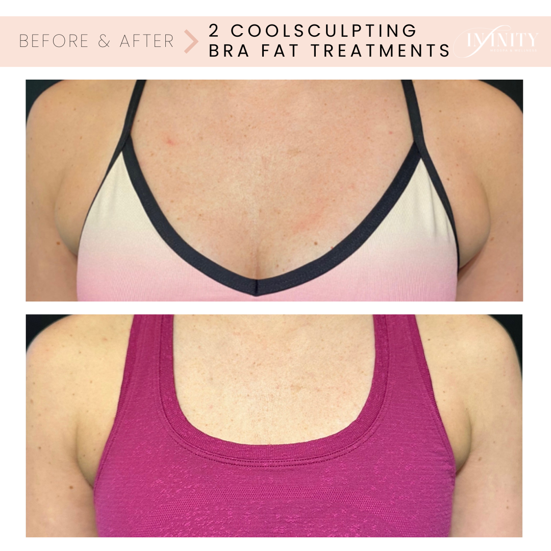 Before & After Coolsculpting elite bra fat treatment infinity medspa charlotte nc- Vertical.png