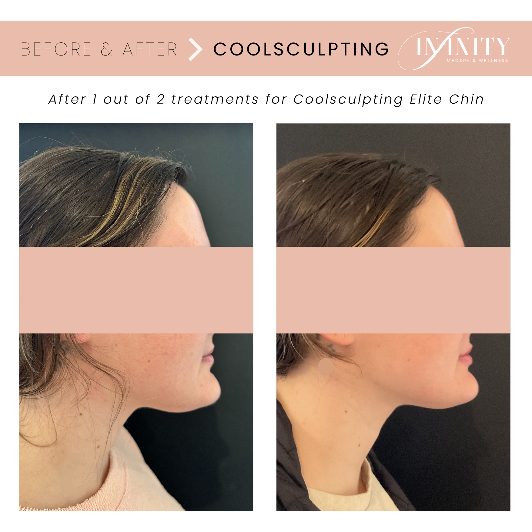 Coolsculpting Elite Double Chin before and after Infinity MedSpa NC.png