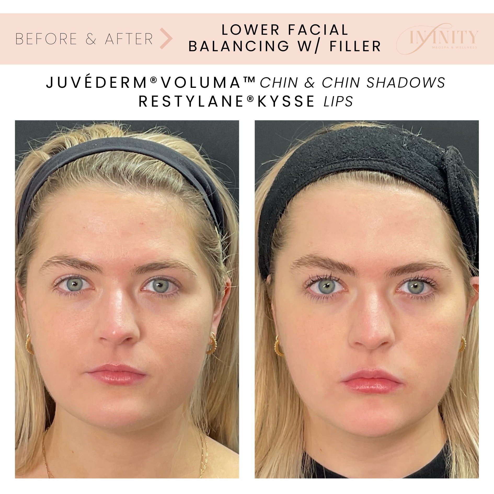 Beautiful before and after of lower face filler with @brooks.np!

Brooks used Juv&eacute;derm Voluma to elongate the chin creating a softer jawline + to fill in chin shadows. She used Restylane Kysse to subtly enhance and hydrate her lips!

We LOVE t