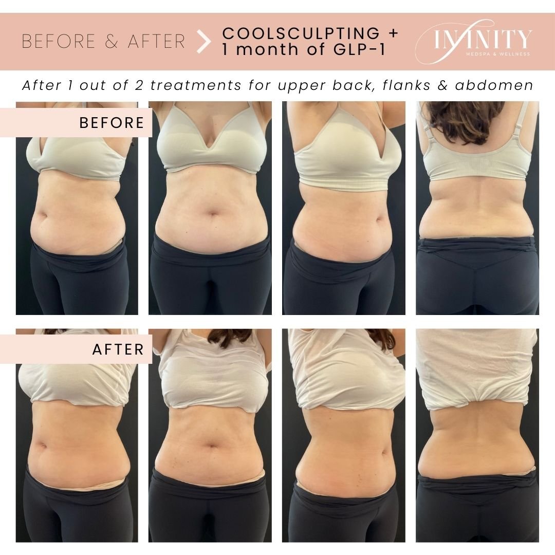 These results are incredible and we are only half way done! 😍

Our Body Contouring Specialist, @your_esti_casey, treated this patient's upper back, flanks and abdomen! She is scheduled for her 2nd treatment and we cannot wait to see the results!

Sh